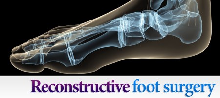 Reconstructive-Foot-Surgery